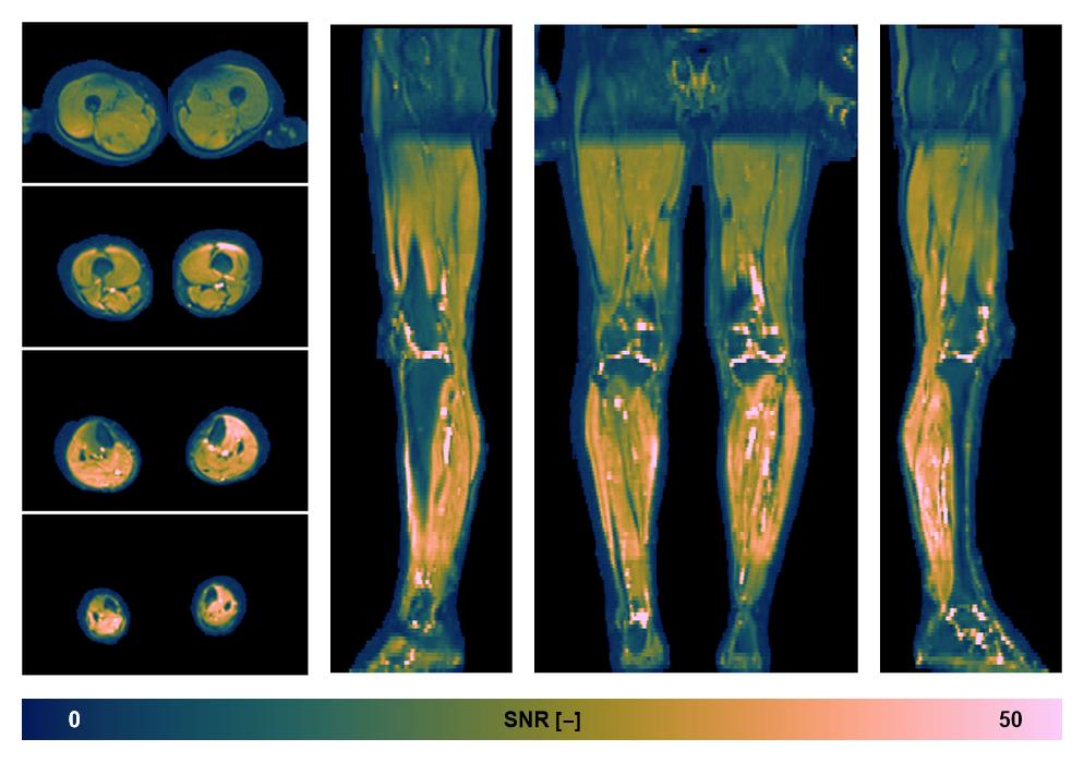 SNR distribution of the unweighted diffusion data.